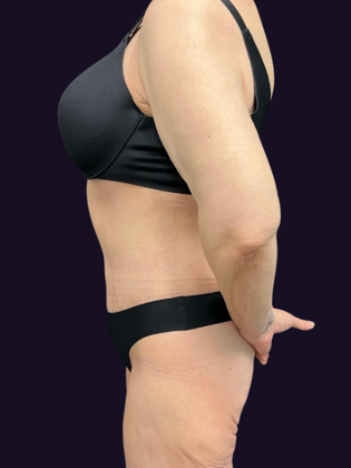 Lower Body Lift: Lower Body Lift 1 - After