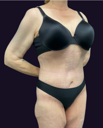 Lower Body Lift: Case 1 - After