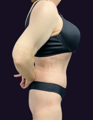 Lower Body Lift: Case 1 - After