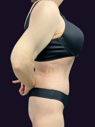 Lower Body Lift: Lower Body Lift 1 - After