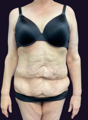 Lower Body Lift Case 1 - Before