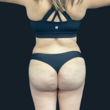 Liposuction Case 6 - After