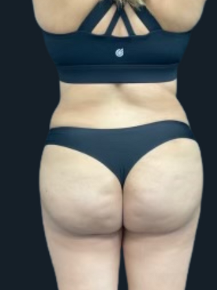 Liposuction: Liposuction 11 - After