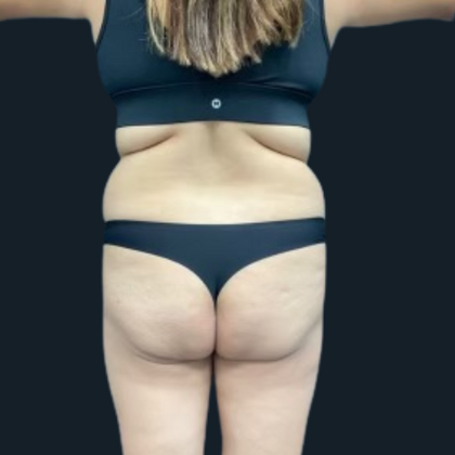 Liposuction Case 6 - Before