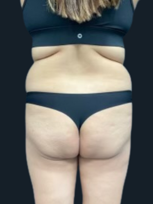 Liposuction: Liposuction 11 - Before