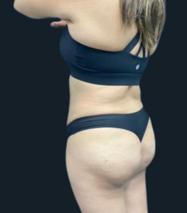 Liposuction: Case 6 - Before