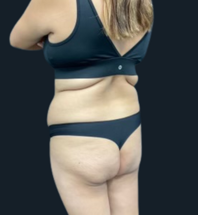 Liposuction: Case 6 - After