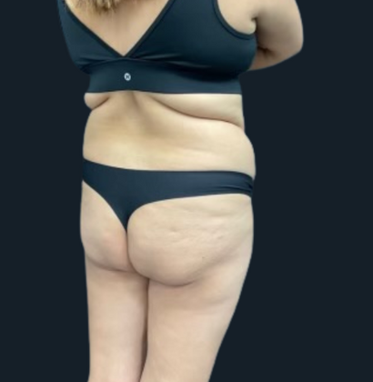 Liposuction: Case 6 - Before