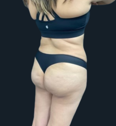 Liposuction: Case 6 - After