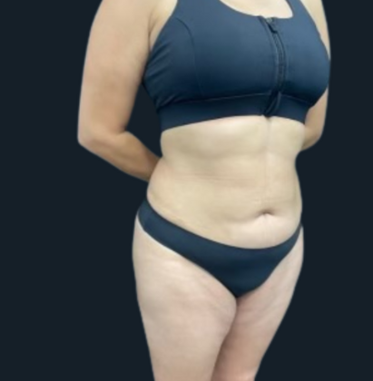 Liposuction: Case 6 - After