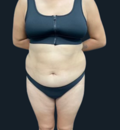 Liposuction: Case 6 - Before