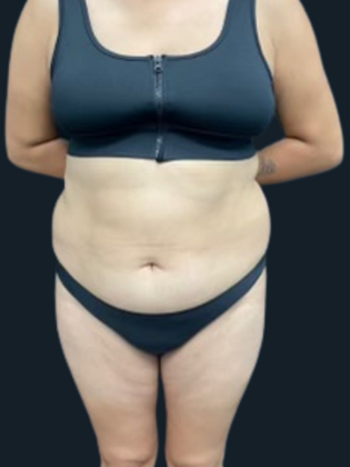 Liposuction Liposuction 11 - Before