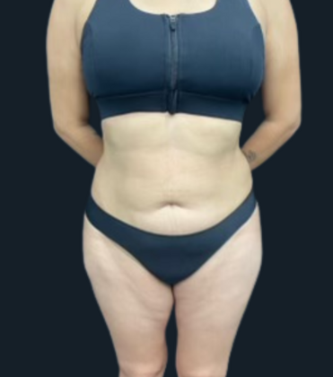 Liposuction: Case 6 - After