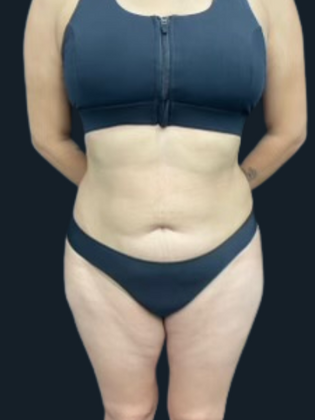 Liposuction Liposuction 11 - After