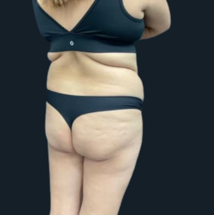 Brazilian Butt Lift: Case 5 - Before