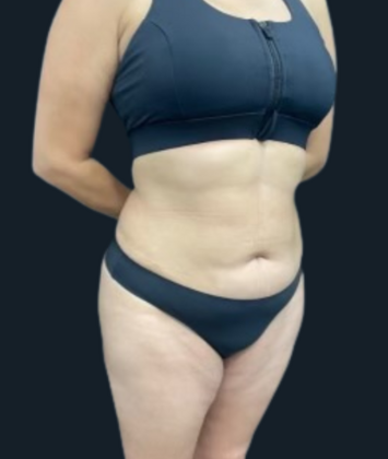 Brazilian Butt Lift: Case 5 - After