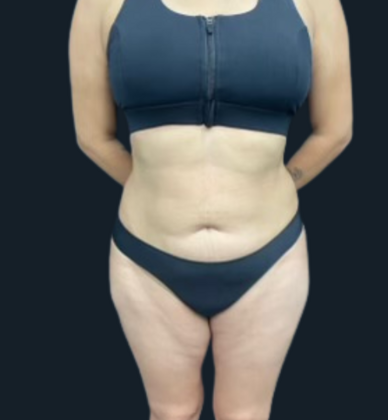 Brazilian Butt Lift: Case 5 - After