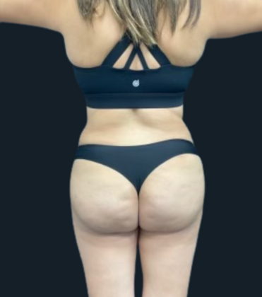 Brazilian Butt Lift: Case 5 - After