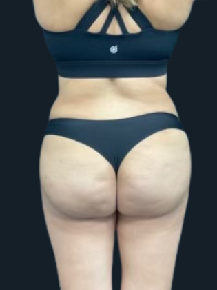Brazilian Butt Lift BBL 6 - After