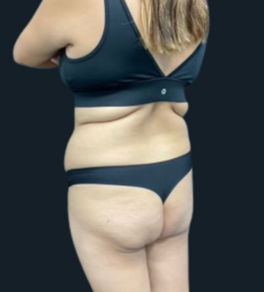 Brazilian Butt Lift Case 5 - Before