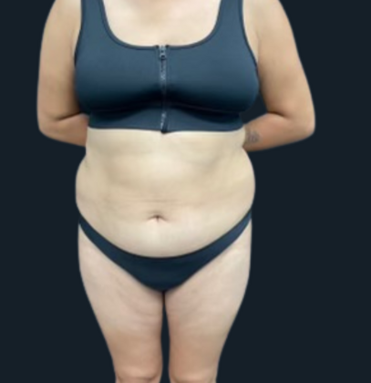 Brazilian Butt Lift: Case 5 - Before