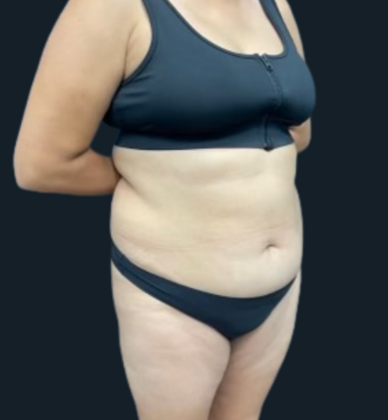 Brazilian Butt Lift: Case 5 - Before