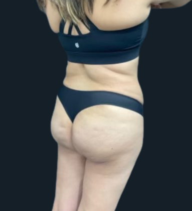 Brazilian Butt Lift: Case 5 - After
