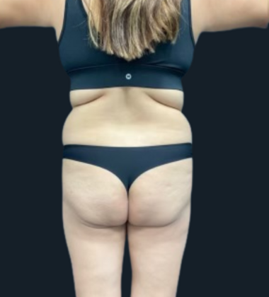 Brazilian Butt Lift: Case 5 - Before