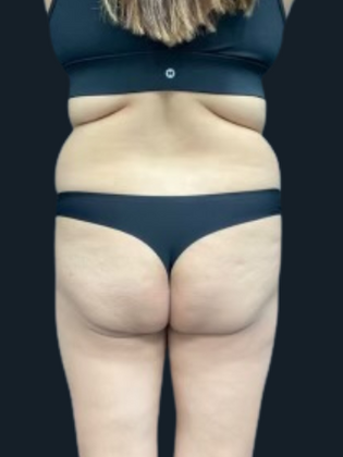 Brazilian Butt Lift BBL 6 - Before