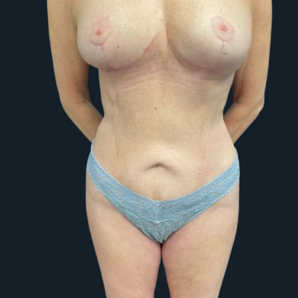 Tummy Tuck Case 2 - After