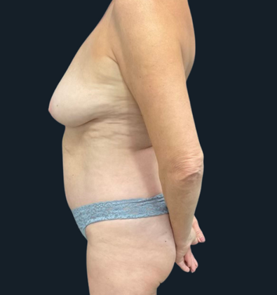 Tummy Tuck: Case 2 - Before
