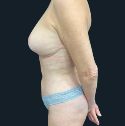 Tummy Tuck: Case 2 - After
