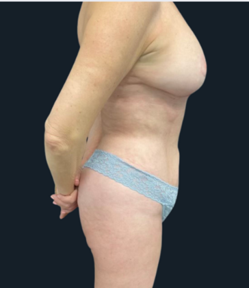 Tummy Tuck: Case 2 - After