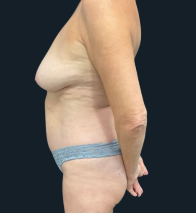 Mastopexy: Case 1 - Before