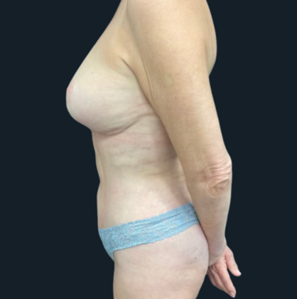 Mastopexy: Case 1 - After