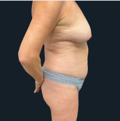 Mastopexy: Case 1 - Before