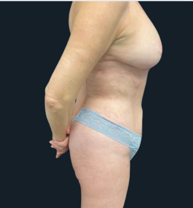 Mastopexy: Case 1 - After