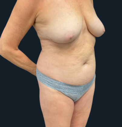 Mastopexy: Case 1 - Before