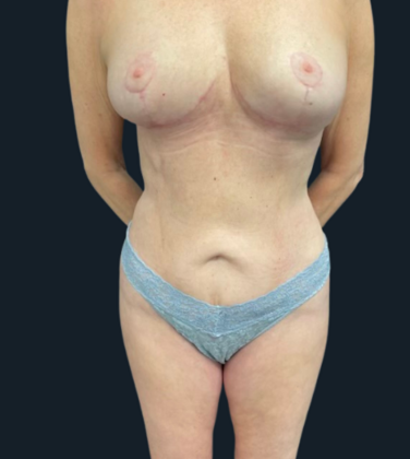 Mastopexy Case 1 - After