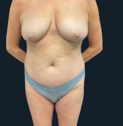 Mastopexy Case 1 - Before