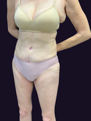 Brazilian Butt Lift: Case 6 - Before