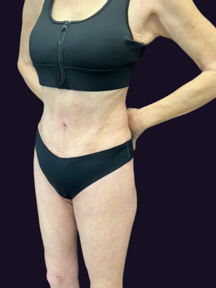 Brazilian Butt Lift: Case 6 - After