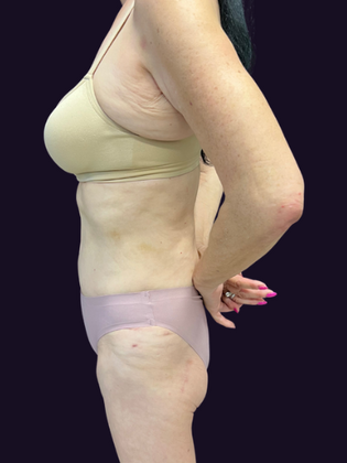 Brazilian Butt Lift Case 6 - Before