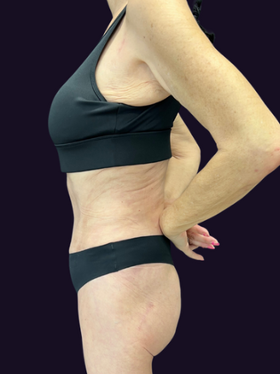 Brazilian Butt Lift Case 6 - After