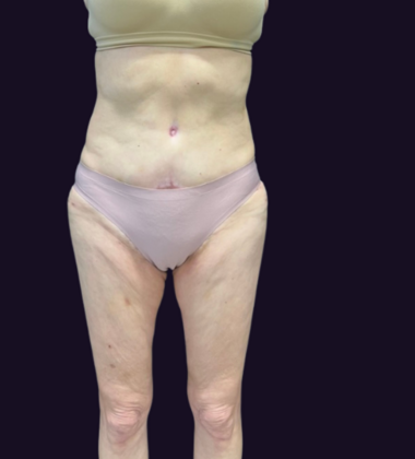Brazilian Butt Lift: Case 6 - Before
