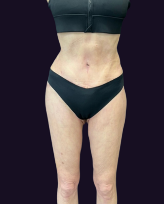 Brazilian Butt Lift: Case 6 - After