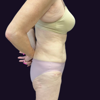 Brazilian Butt Lift: Case 6 - Before