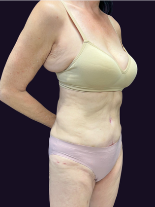 Brazilian Butt Lift: Case 6 - Before