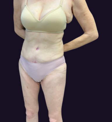 Liposuction: Case 7 - Before