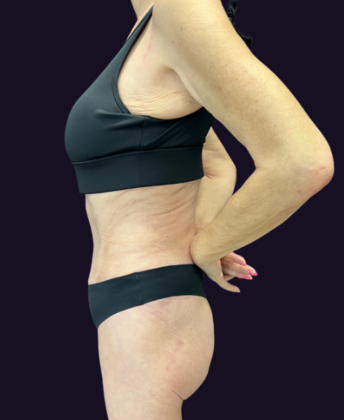 Liposuction: Case 7 - Before